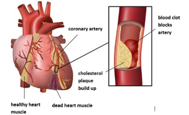 Coronary heart disease (CHD)