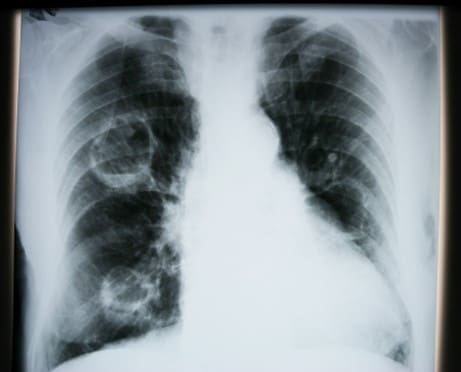 Lung cancer