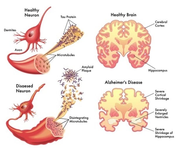 the deterioration of the brain