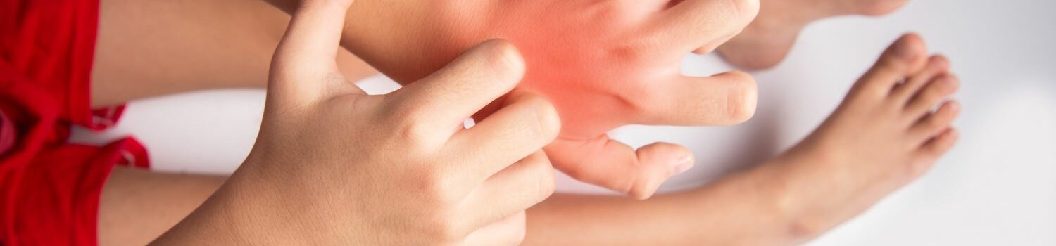 Understanding and Managing Allergies in Children Understanding and Managing Allergies in Children