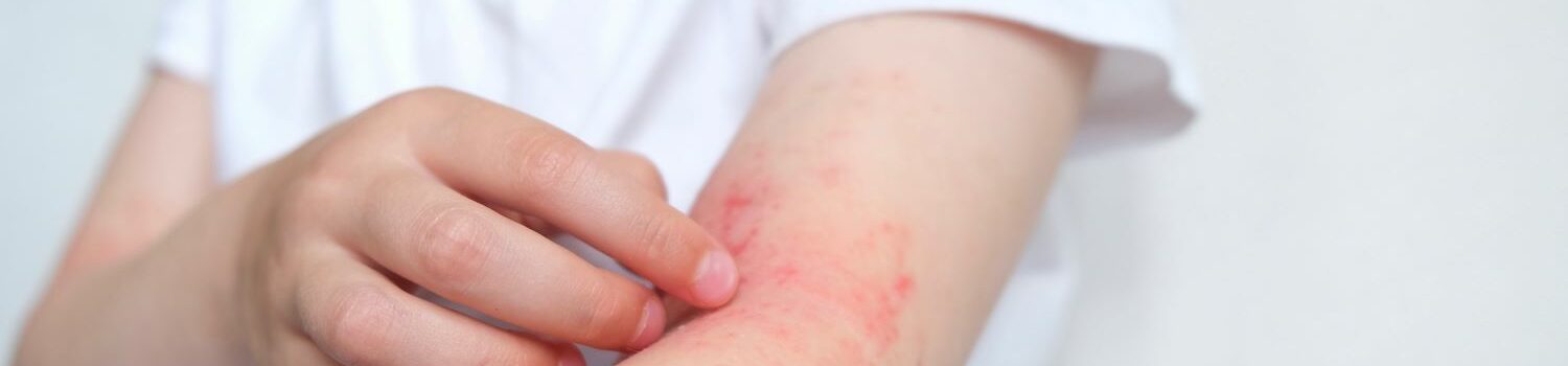 Understanding and Managing Allergies in Children